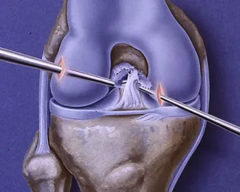 ACL-Reconstruction