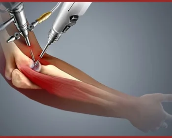 Elbow20Replacement201