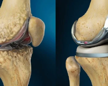 Facts-About-Total-Knee-Replacement-You-Must-Know