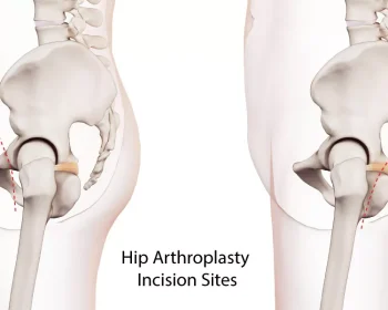 Hip-Arthroplasty-Incision-Sites_Web-jpg