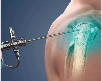 SHOULDER-ARTHROSCOPY