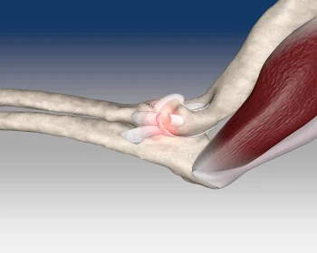 Stabilisation-de-la-lucation-du-coude
