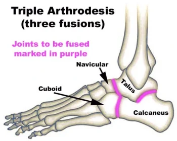 Triple-arth-schematic