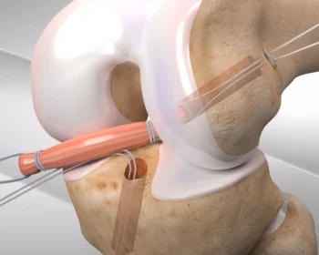 arthrex-bild-bohrlockbeitrag_InPixio-scaled