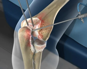 arthrodebridement_1280