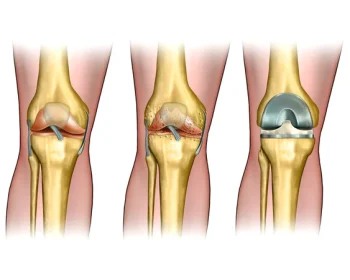 depositphotos_11327096-stock-photo-knee-replacement