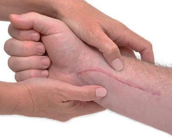 hand-and-wrist-ligament-reconstruction