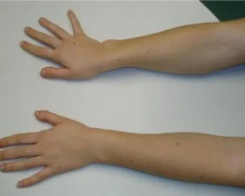 madelungs20deformity