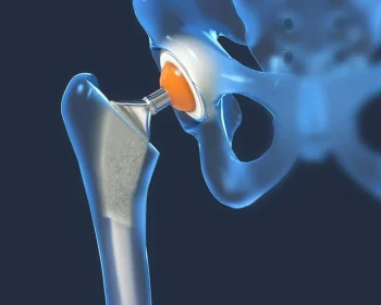 primaryhipreplacement