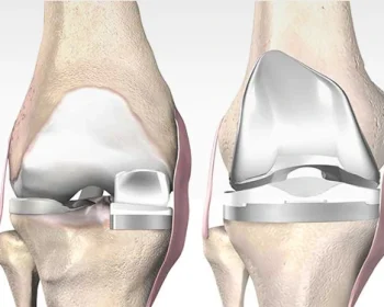 unicondylar-knee-replacement