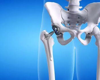 what-is-a-total-hip-replacement